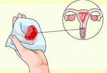 Đặt vòng tránh thai bị rong kinh phải xử lý ra sao?
