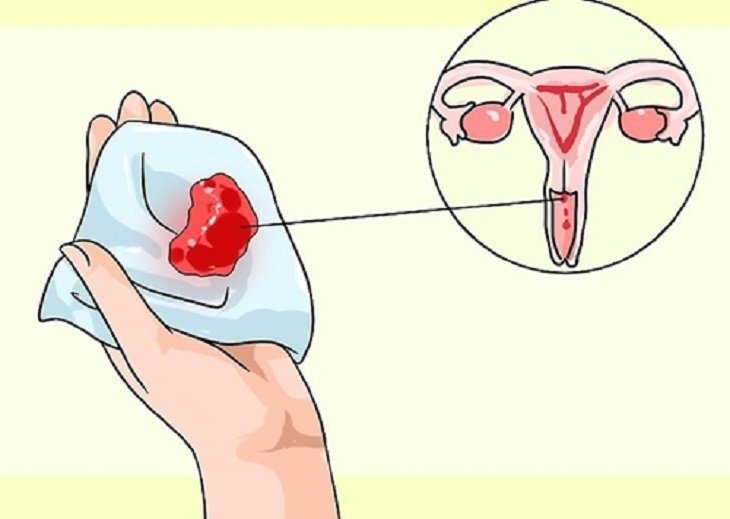 Đặt vòng tránh thai bị rong kinh phải xử lý ra sao?