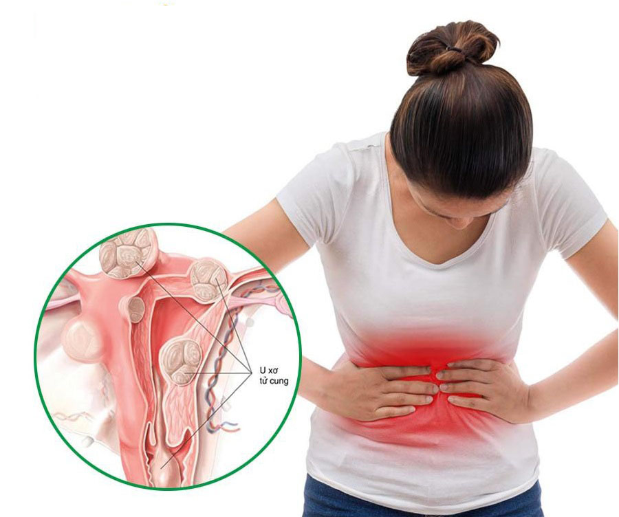 Tìm hiểu về u xơ tử cung ở tuổi tiền mãn kinh