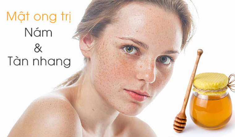 3 cách trị tàn nhang bằng mặt ong hiệu quả tại nhà