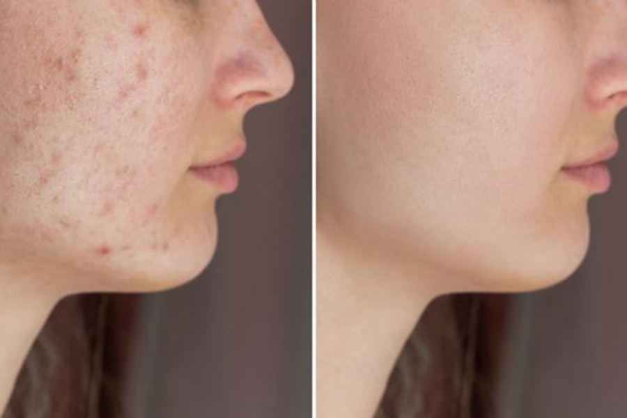 4 cách trị vết thâm sau mụn trứng cá hiệu quả