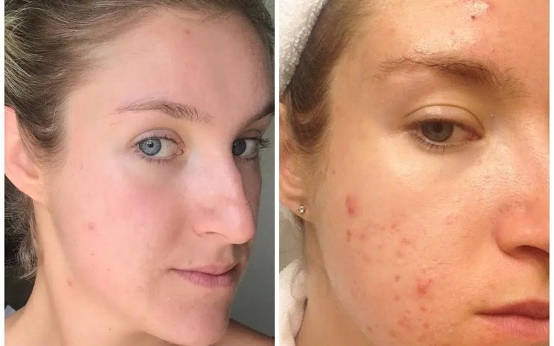 Biểu hiện dư estrogen chị em cần chú ý