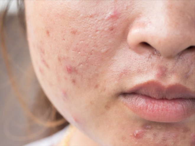 Cách khắc phục hiệu quả tình trạng: da dầu, nổi mụn và lỗ chân lông to!