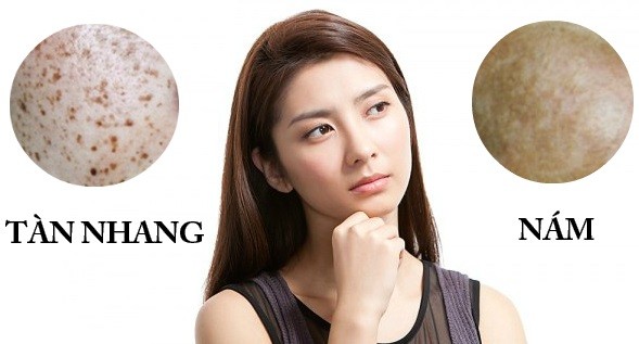 Cách phân biệt nám và tàn nhang ở phụ nữ