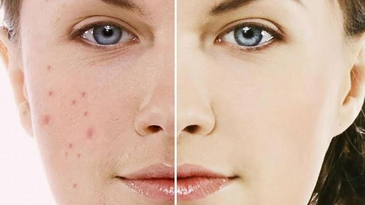 Cách trị vết thâm sau mụn hiệu quả