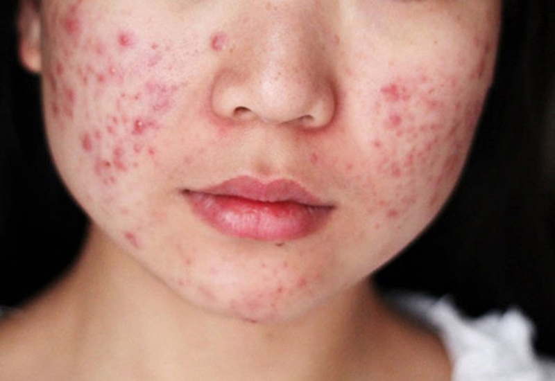 Nguyên nhân mụn trứng cá thường xuyên “làm loạn”