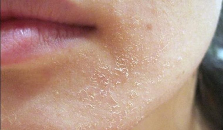 Tình trạng da khô nứt nẻ phải làm sao