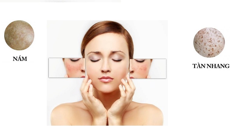 Phân biệt nám và tàn nhang trên da không khó