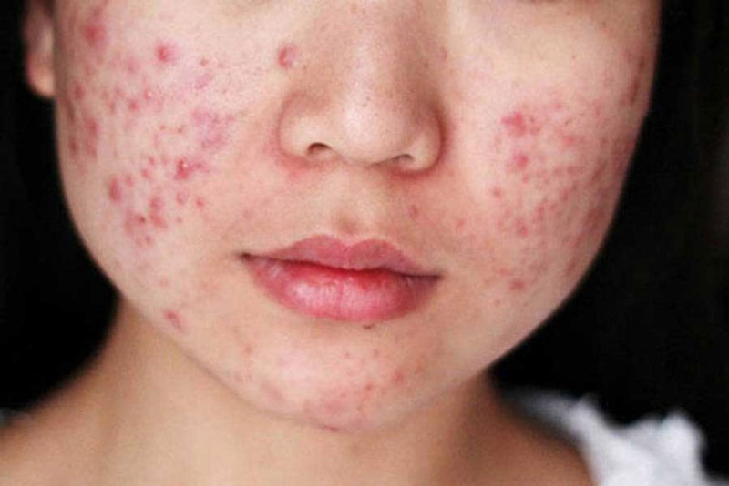 Rối loạn nội tiết tố nữ gây mụn nguyên nhân do đâu