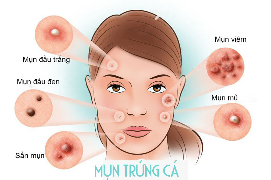 Những điều cần biết về mụn trứng cá ở người lớn