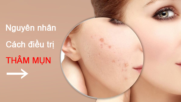 Thổi bay vết thâm sâu mụn cho da dầu