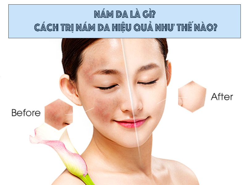Nám da là bệnh gì và phương pháp hỗ trợ điều trị