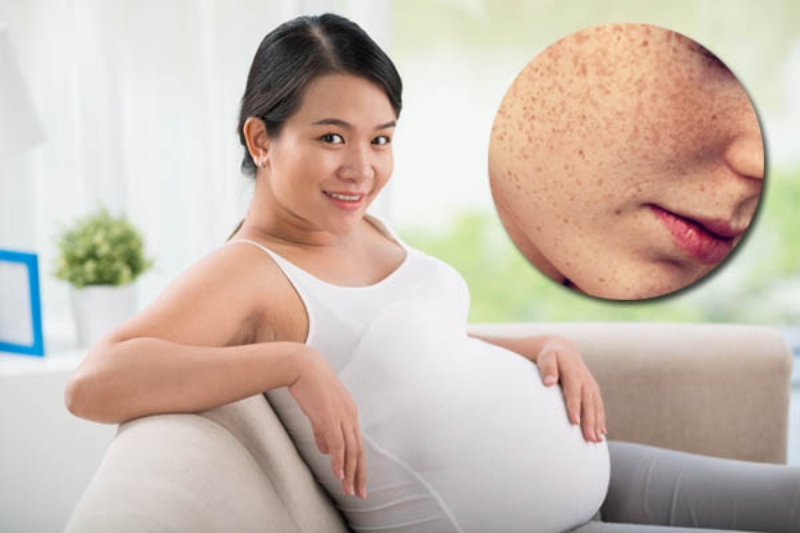 Cách hỗ trợ cải thiện nám da cho bà bầu an toàn mà hiệu quả