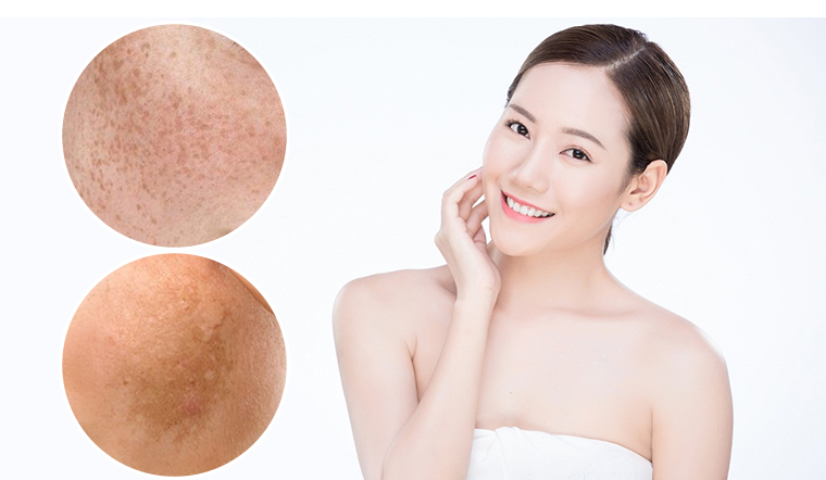 Giải pháp trị nám, dưỡng trắng da hiệu quả