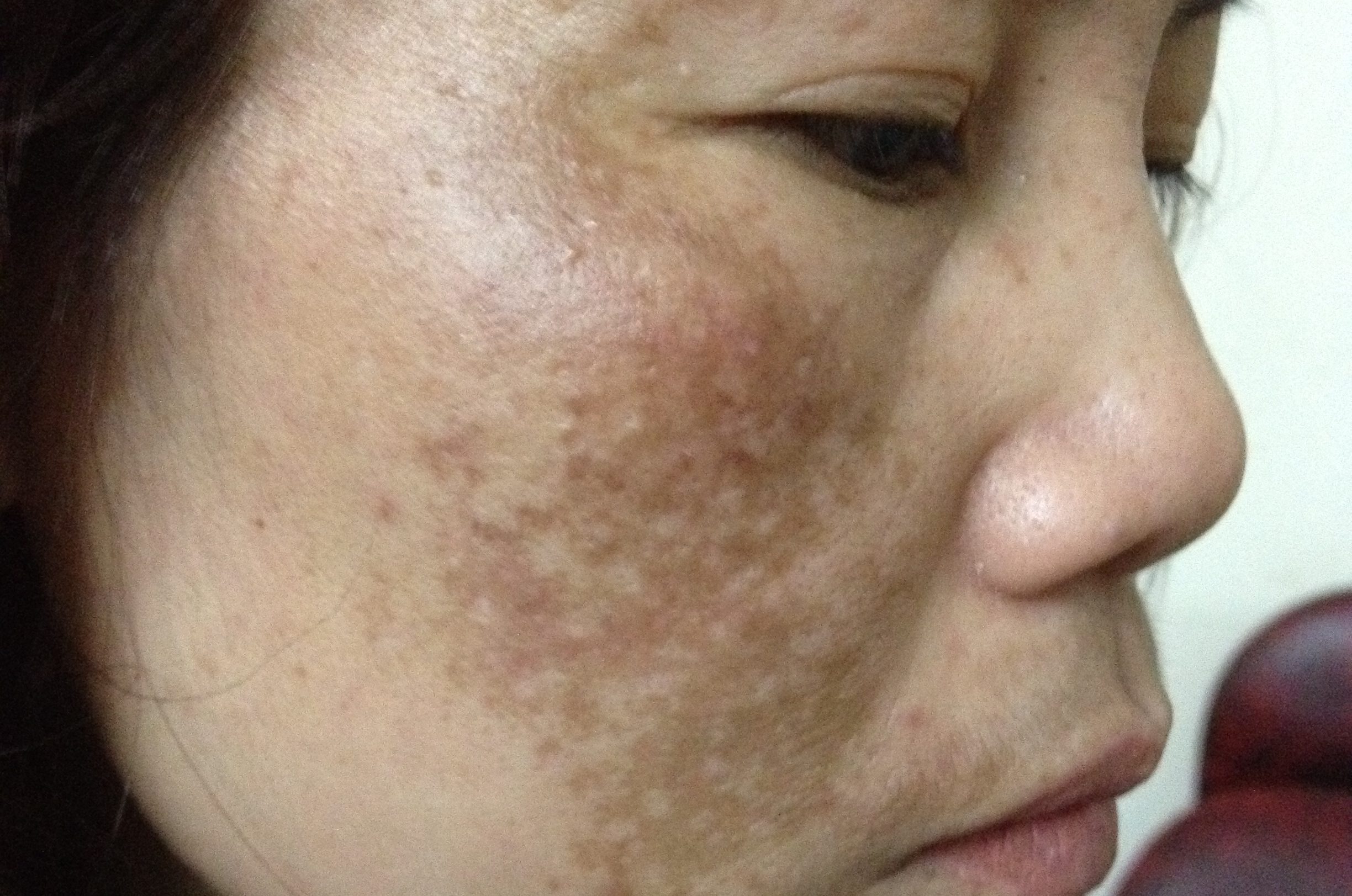 Những nguyên nhân chính khiến việc trị nám da thất bại