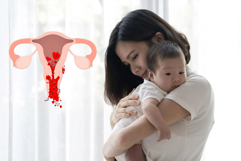 Rong kinh nguyệt sau sinh làm thế nào?